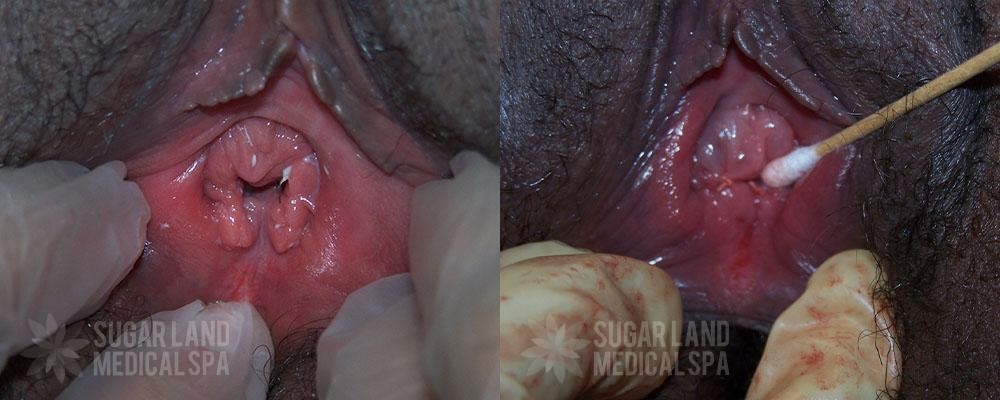 Patient 3 Hymenoplasty Before and After