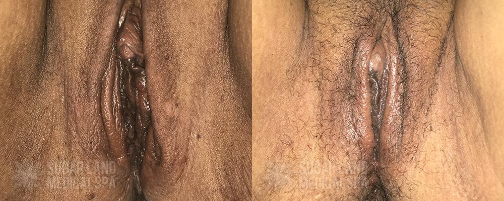 Vaginoplasy Sugar Land Med Spa Before and After