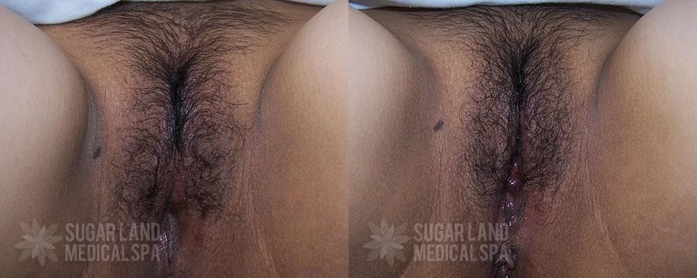 Patient 2 Radiofrequency Before and After