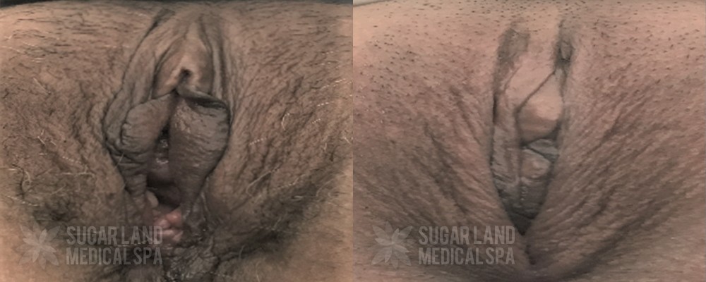 Patient 2-1 Vaginoplasty and Perineoplasty Before and After