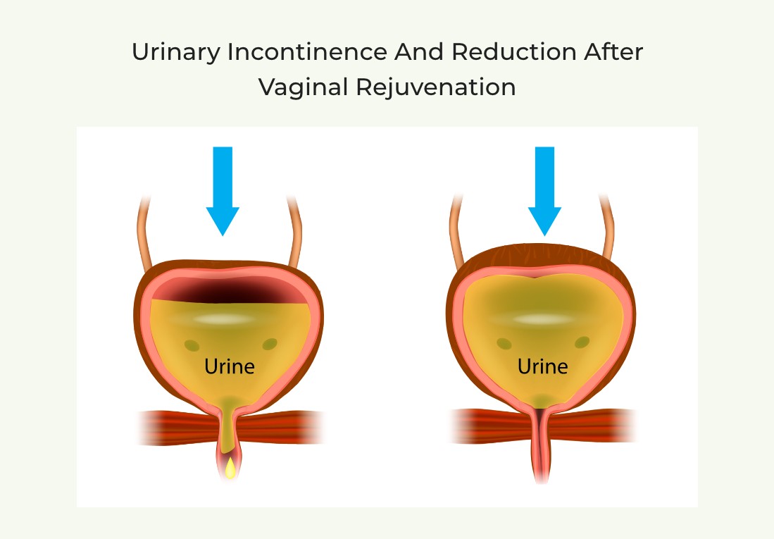 Urinary Incontinence and Reduction After Vaginal Rejuvenation