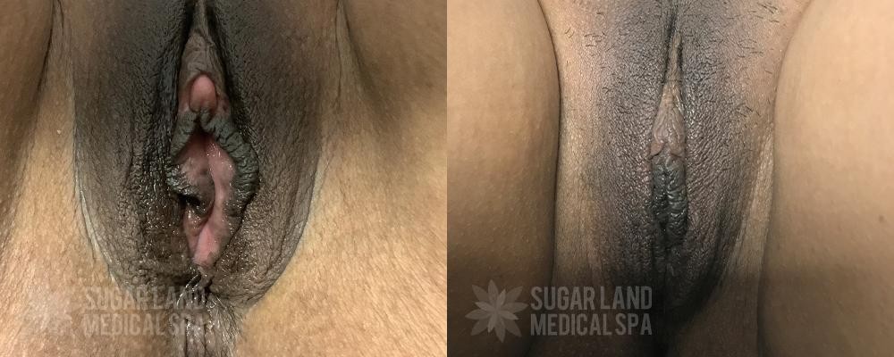 Ultra Femme Patient Sugar Land Med Spa Before and After 1